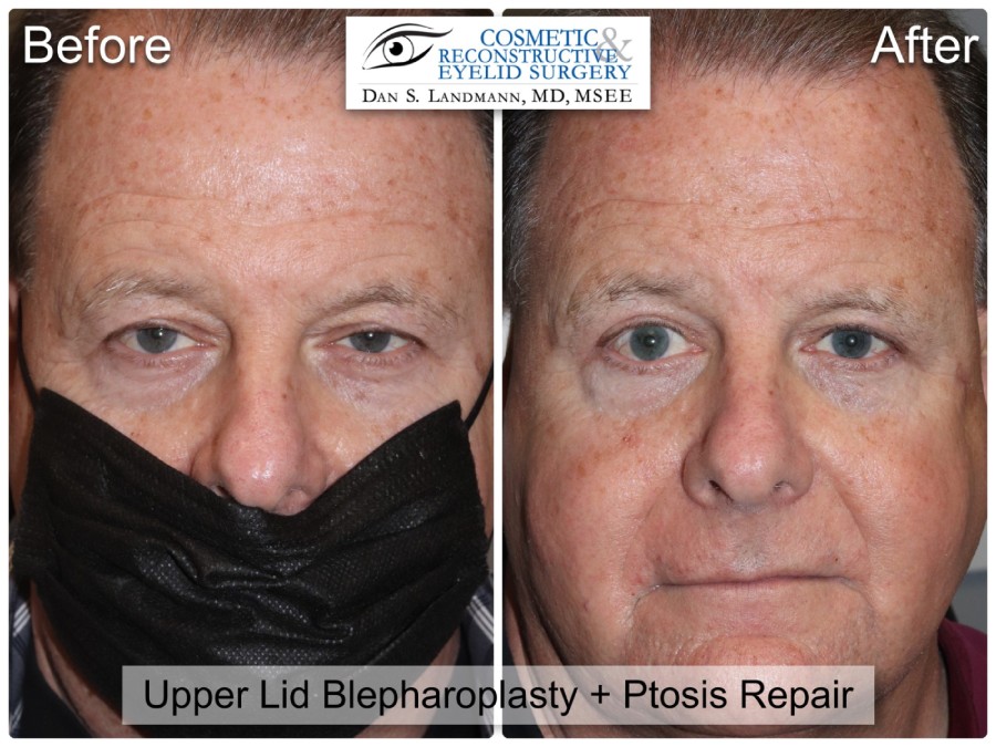 Before and after photos of Upper Lid Blepharoplasty and Ptosis Repair at Cosmetic & Reconstructive Eyelid Surgery in River Edge, NJ.