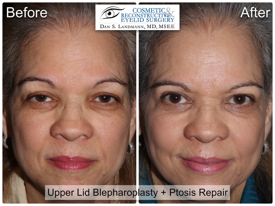 Before and After Image Upper Eyelid Blepharoplasty at Cosmetic & Reconstructive Eyelid Surgery in River Edge, New Jersey.