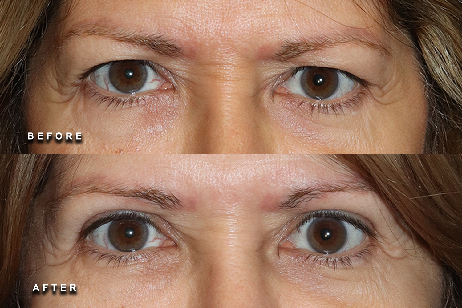 Upper eyelid surgery before and after example