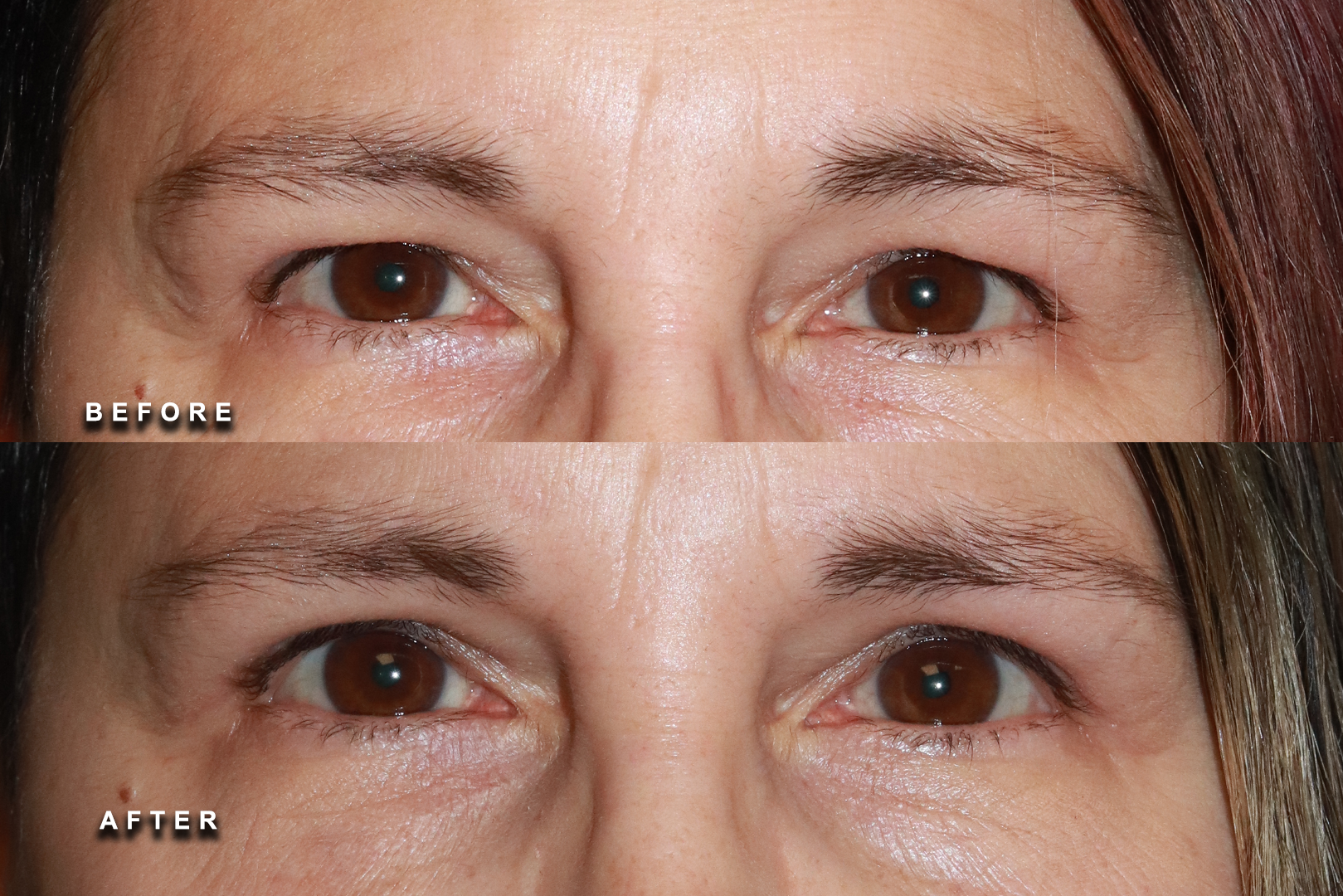 Ptosis evaluation and treatment area