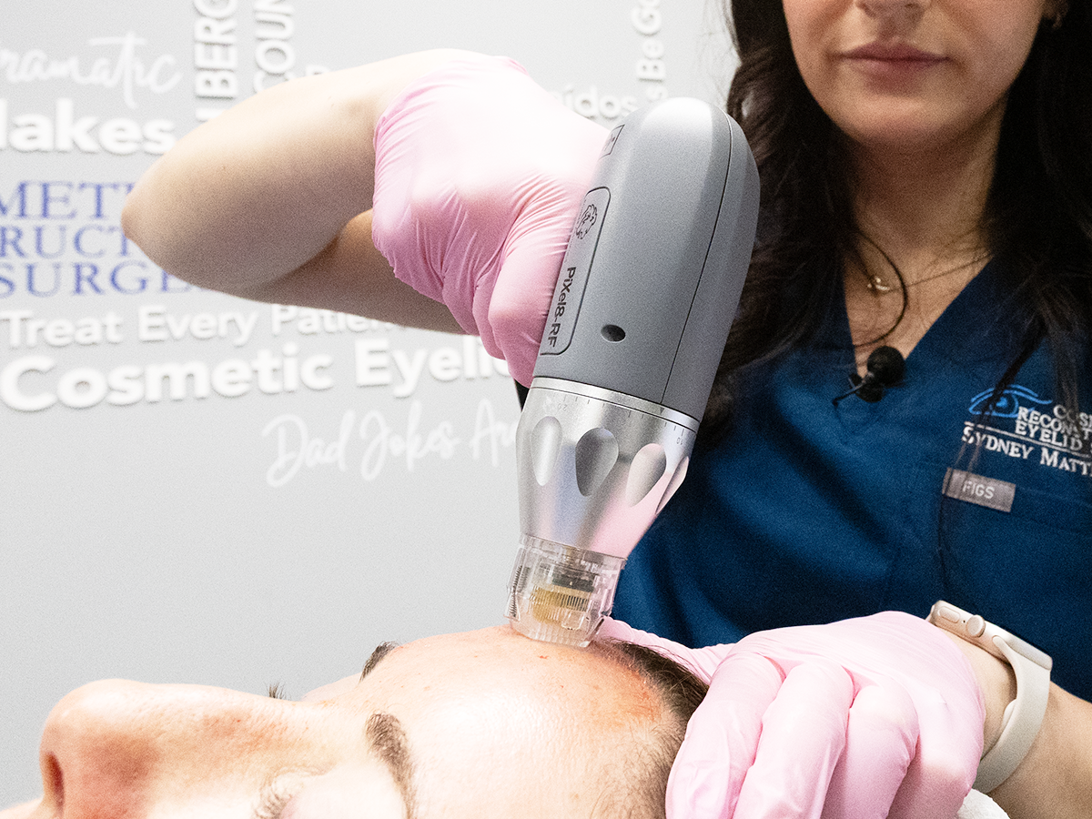 RF microneedling treatment performed at Bergen Eyelids