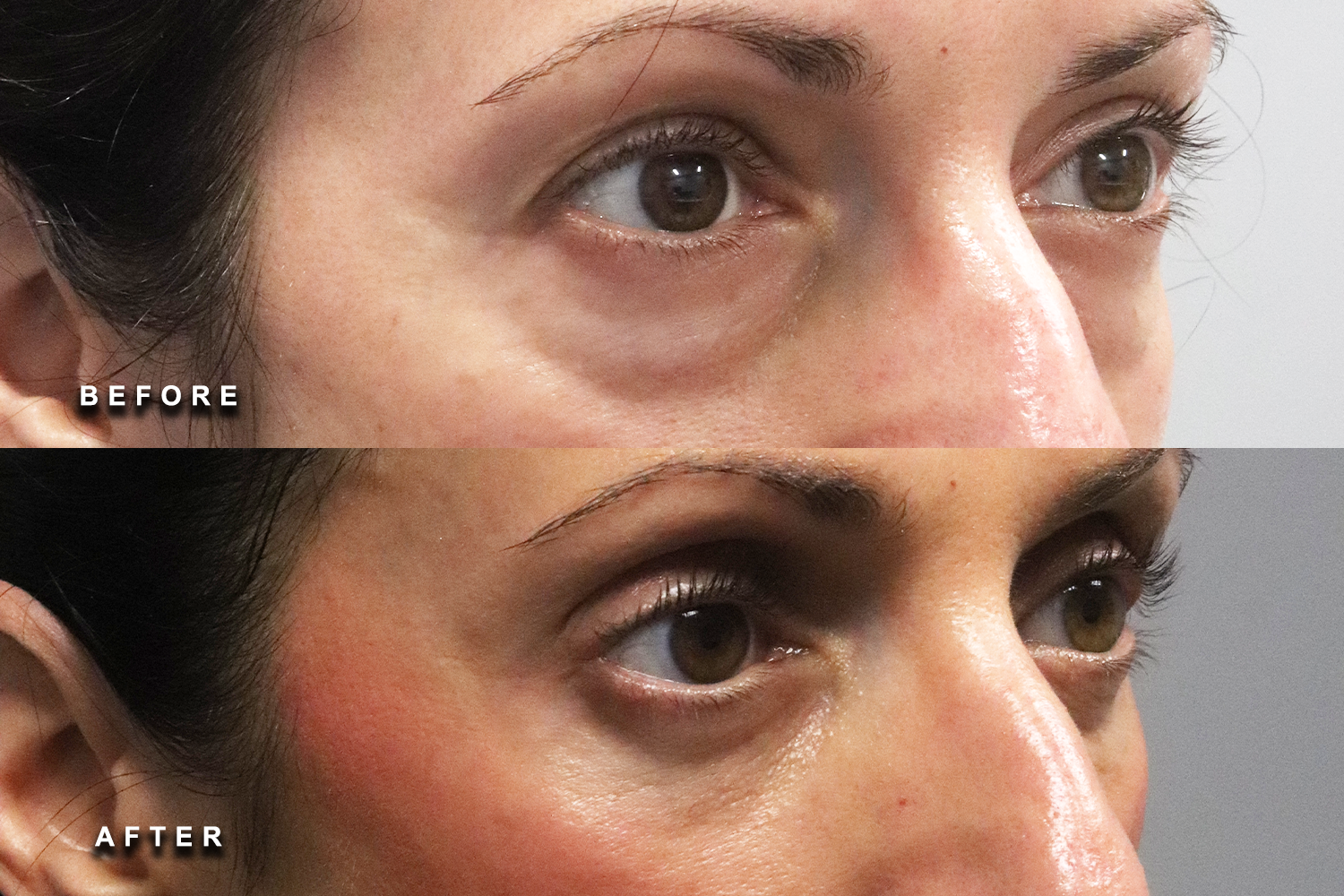 Lower eyelid treatment area