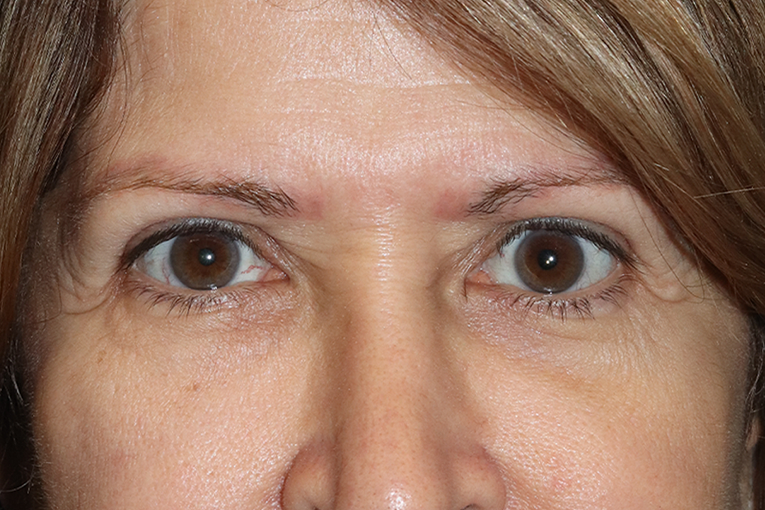 After eyelid surgery