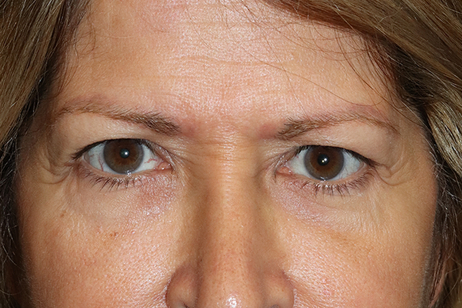 Before eyelid surgery