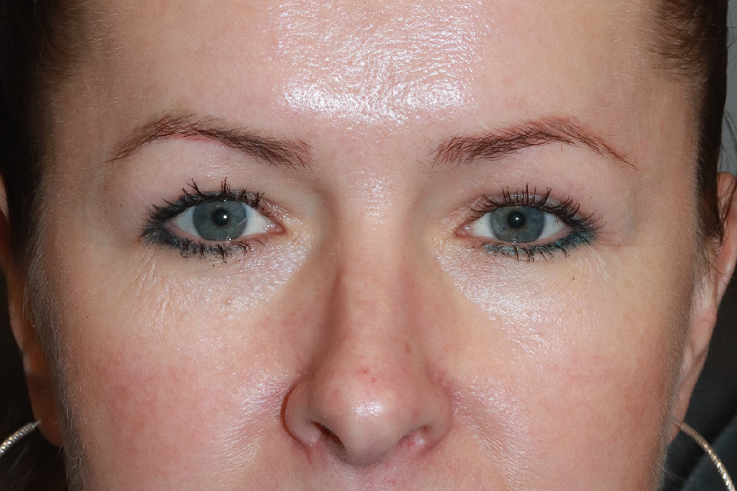 After treatment