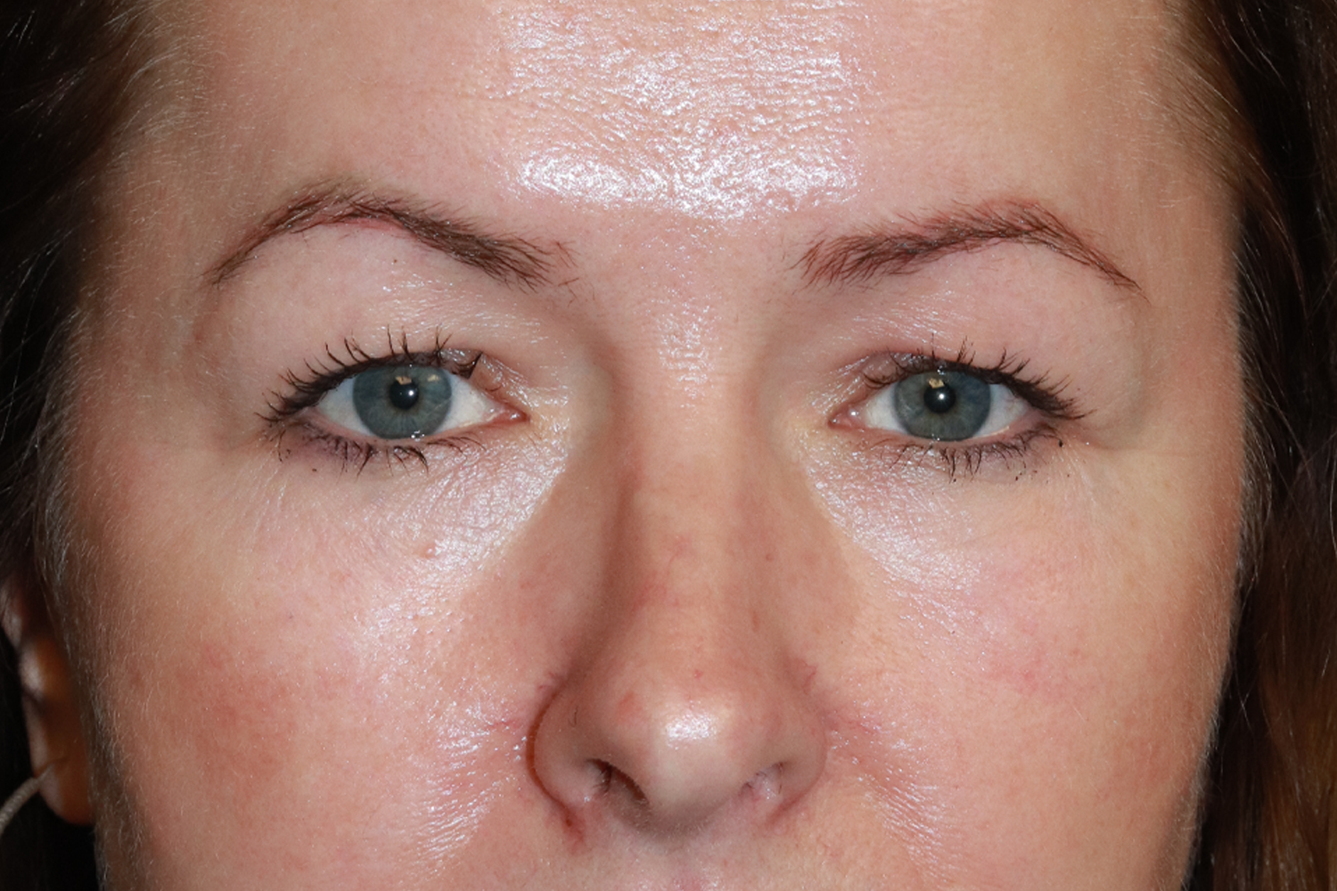 Before treatment