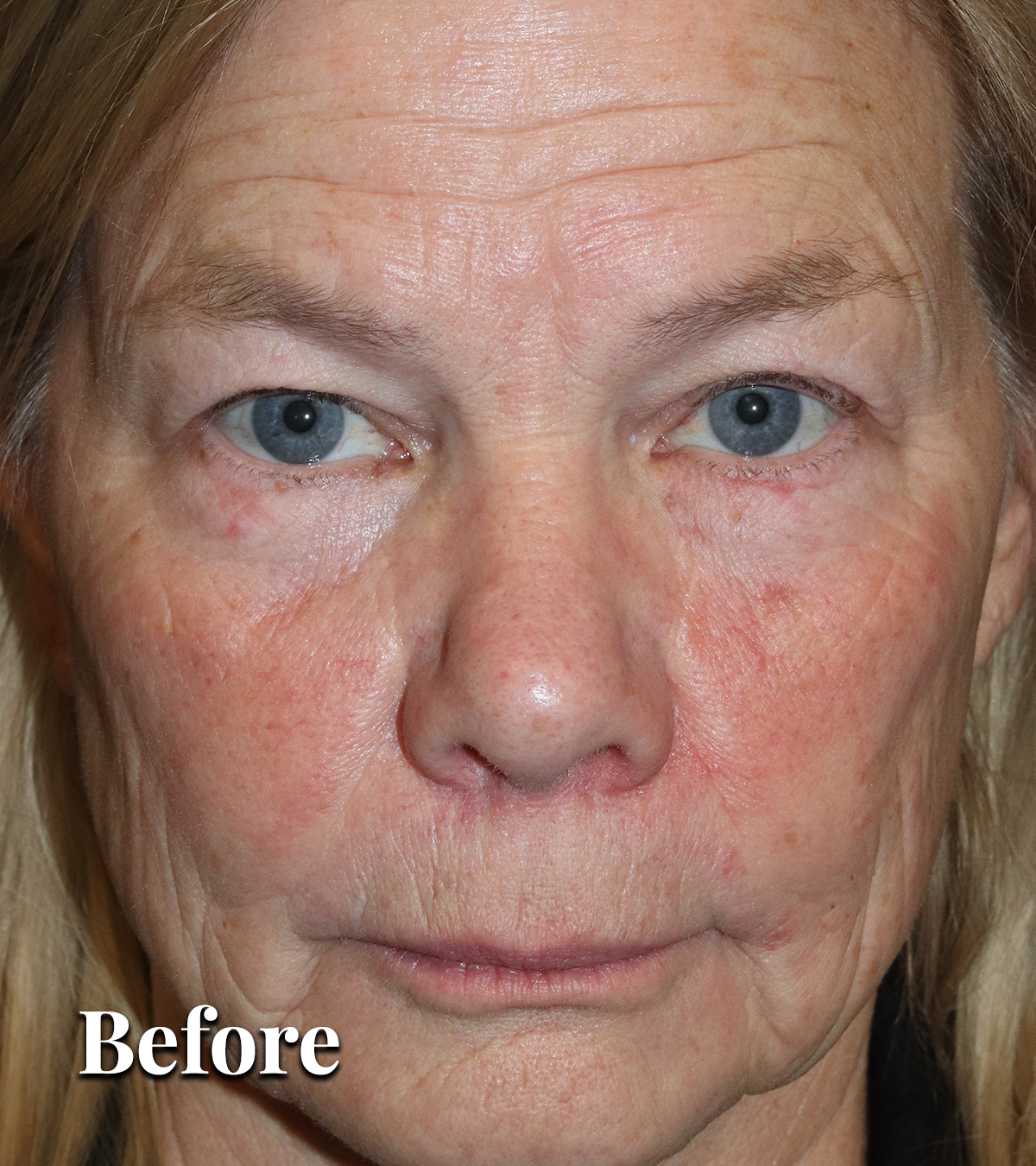 Before Upper Eyelid treatment
