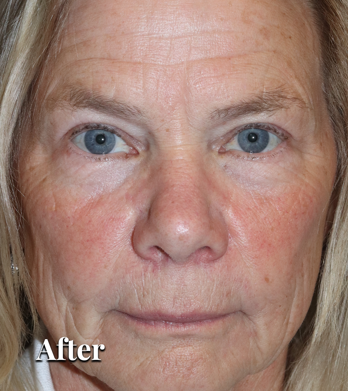 After upper eyelid treatment