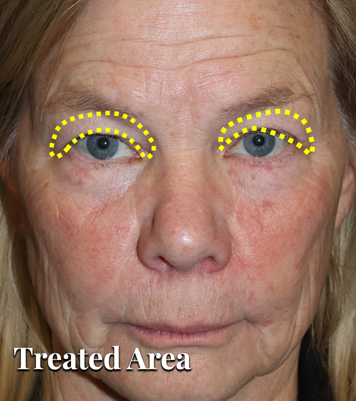 Annotated upper eyelid hooding treatment area