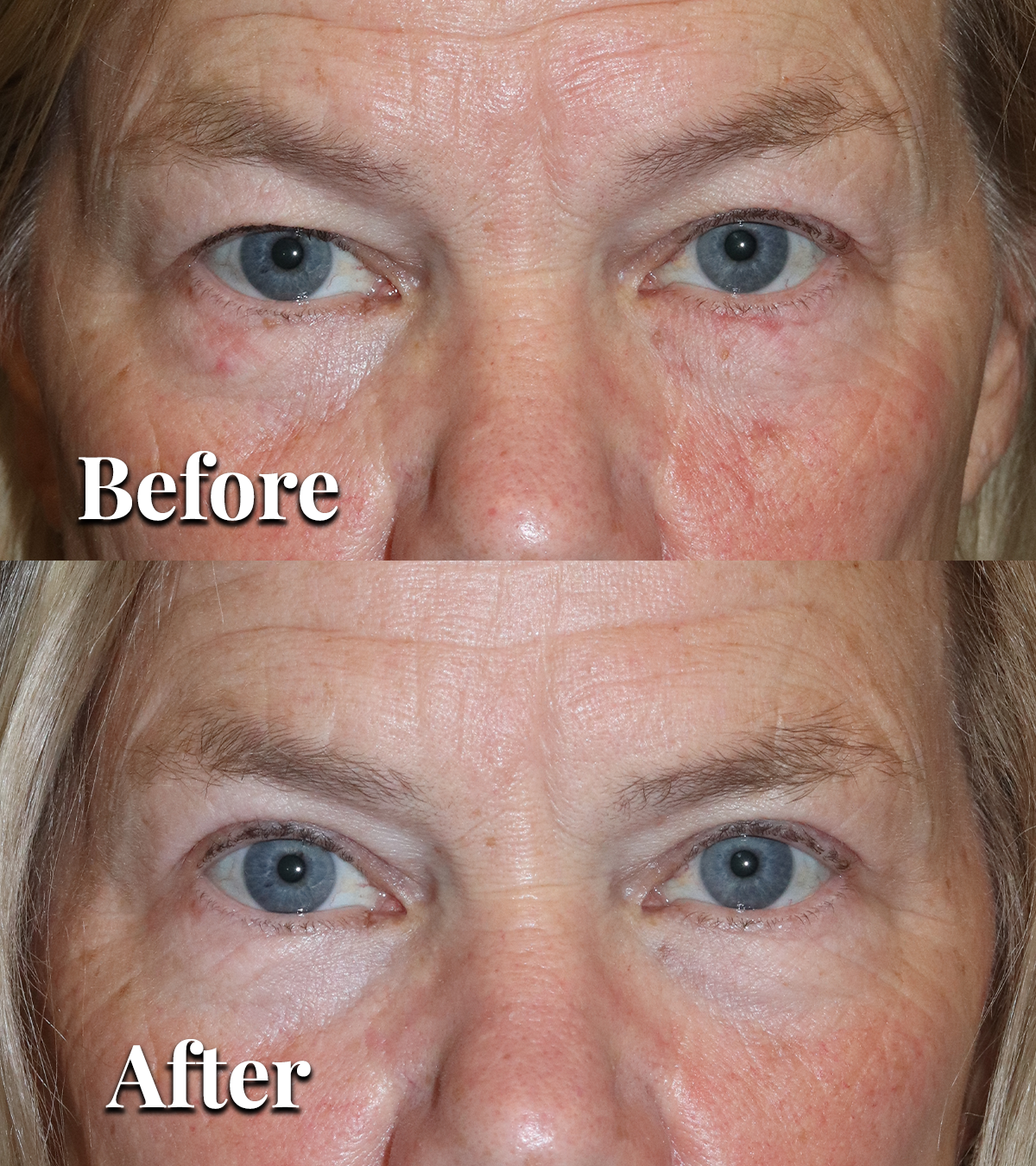 Annotated comparison of upper eyelid hooding and ptosis
